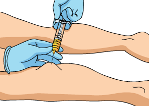 Baker's Cyst Aspiration Baker's Cyst Aspiration