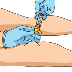 Bakers Cyst