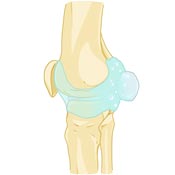Bakers Cyst Causes Bakers Cyst Causes