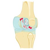 Bakers Cyst Causes Bakers Cyst Causes