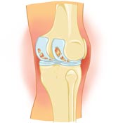 Bakers Cyst Causes Bakers Cyst Causes