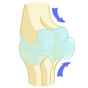 Baker's Cyst Rupture Baker's Cyst Rupture
