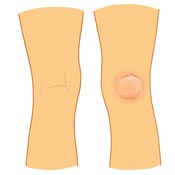 Baker's Cyst Rupture Baker's Cyst Rupture