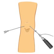 Baker's Cyst Surgery Baker's Cyst Surgery