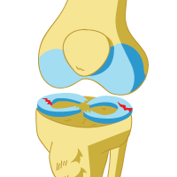 Meniscus Tear