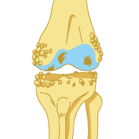 Osteoarthritis