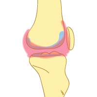 Rheumatoid Arthritis