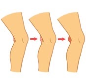 Bakers Cyst Symptoms Bakers Cyst Symptoms