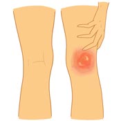 Bakers Cyst Symptoms