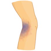 Bakers Cyst Symptoms Bakers Cyst Symptoms