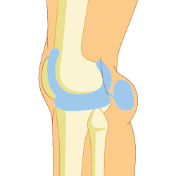 Bakers Cyst