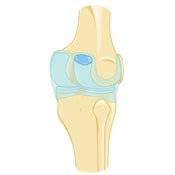 What is a Bakers Cyst What is a Bakers Cyst