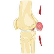 What is a Bakers Cyst What is a Bakers Cyst