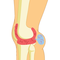 Bakers Cyst